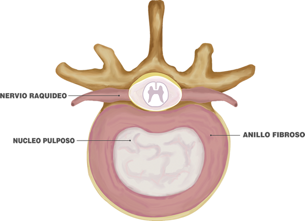 protusión disco intervertebral