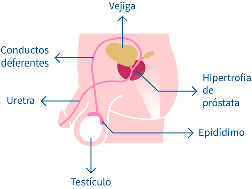 hipertrofia benigna prostata