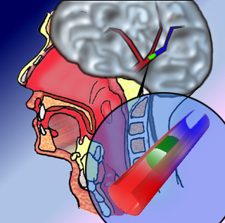Accidente-cerebro-vascular
