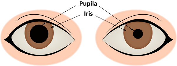 Anisocoria