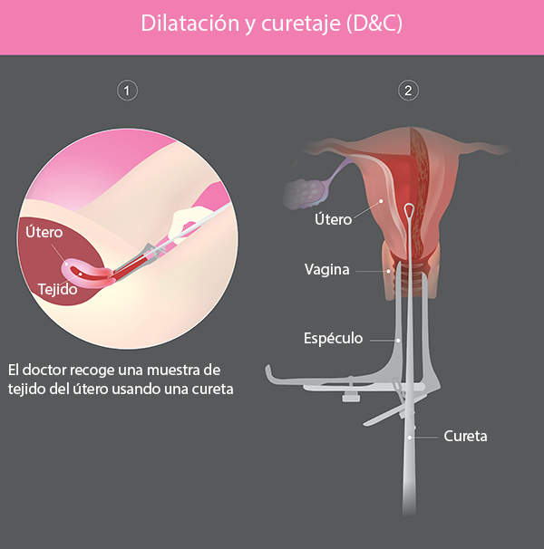 Dilatación y Curetaje