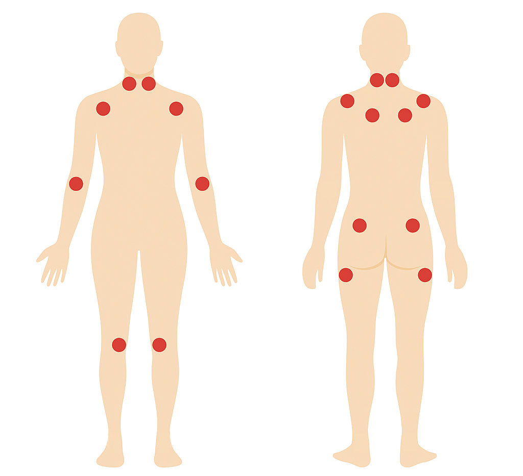 Fibromialgia