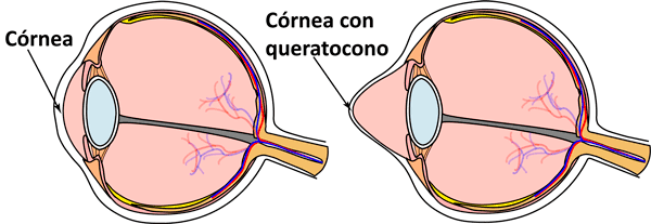 Queratocono