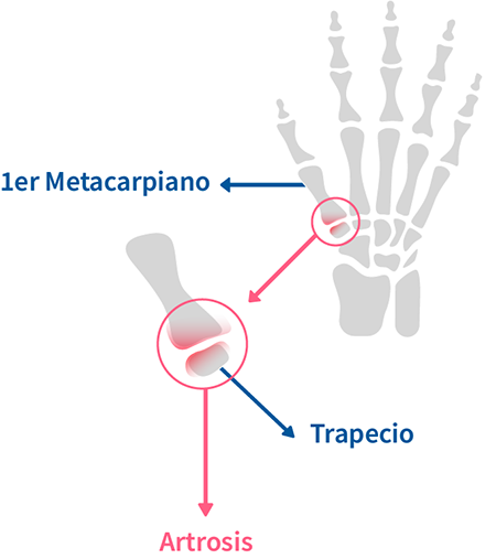 RIZARTROSIS