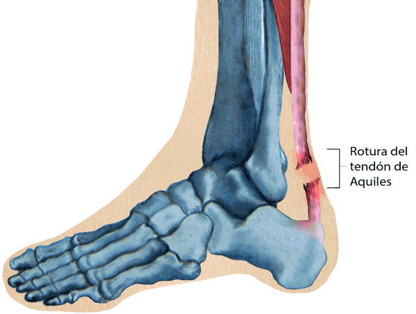 Rotura del tendón de Aquiles