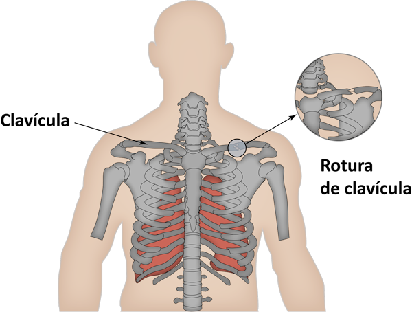 terminado Volar cometa Cardenal Fractura de clavícula. Fractura clavicular. Rotura de clavícula