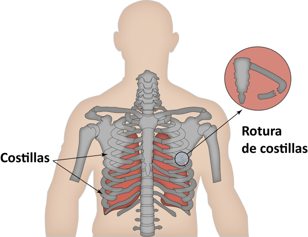 Rotura de costillas