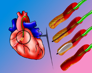 Angioplastia