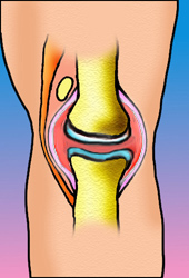 Artritis reumatoide