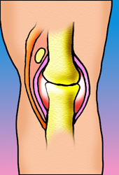 Osteoartritis