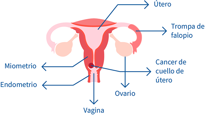 cancer cuello utero