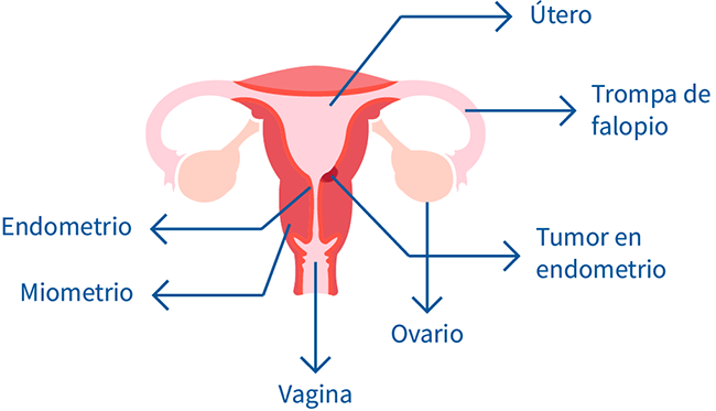 cancer endometrio