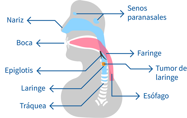 cancer laringe