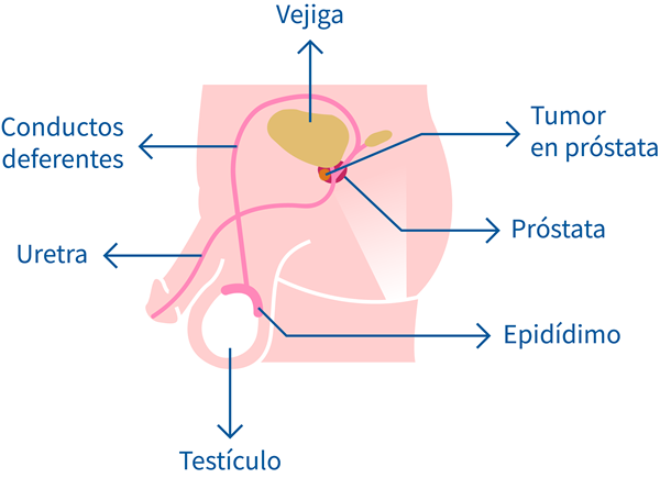 masa de prostatita)