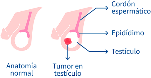 Cancer en los testículos