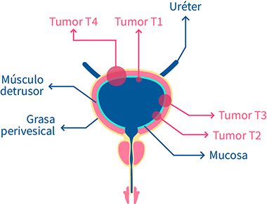 cancer vejiga