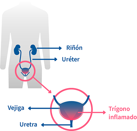 cistitis de la luna de miel