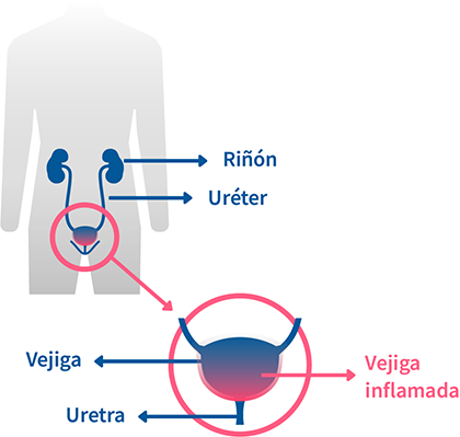 cistitis