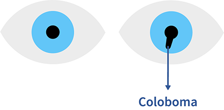 Coloboma