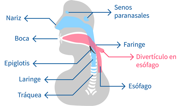 diverticulo zenker