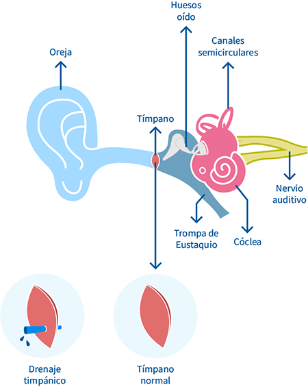 drenaje timpanico