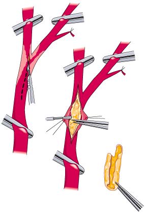 Endarterectomía carotidea