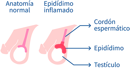 Epididimitis