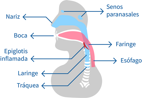 epiglotitis