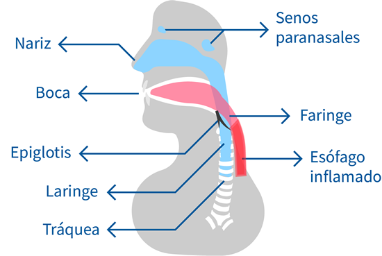 esofagitis eosinofilica