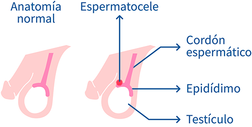 Espermatocele