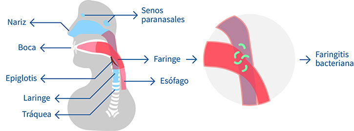 faringitis bacteriana