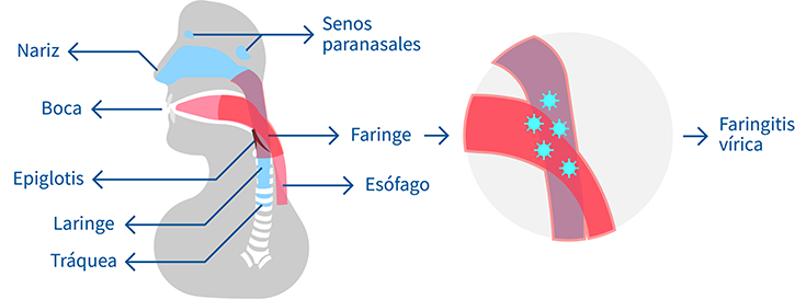 faringitis virica