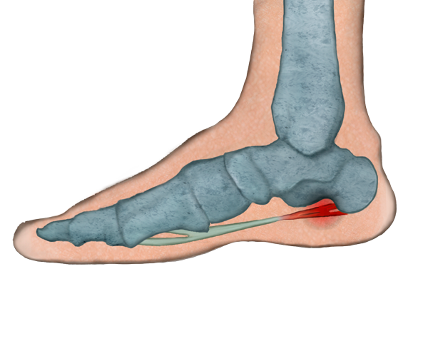 Fascitis plantar