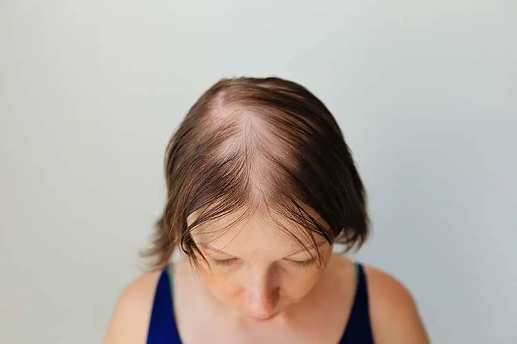 Foto principal de Alopecia areata