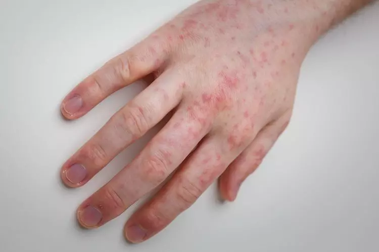 Foto principal de Dermatitis de las manos