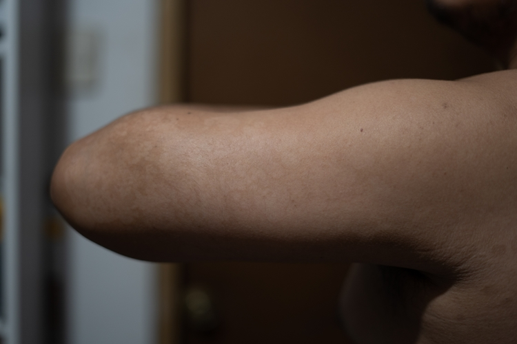 Foto principal de Pitiriasis Versicolor