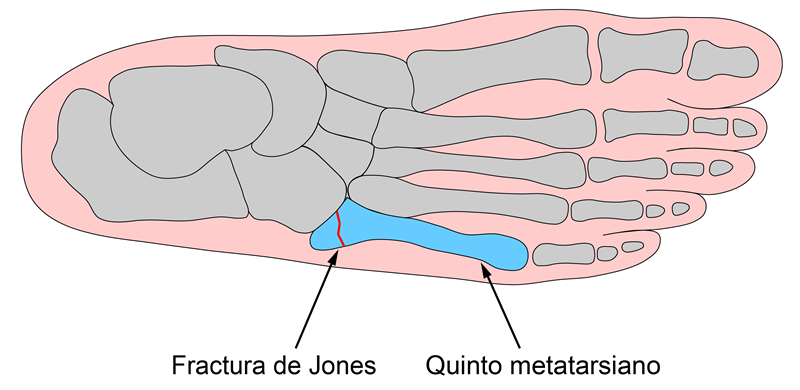 Fractura quinto metatarsiano