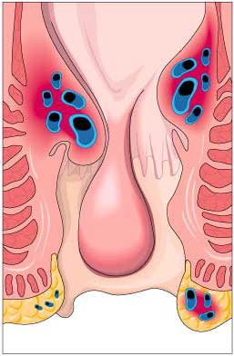 como es la cirugia de hemorroides internas como es la cirugia de hemorroides internas