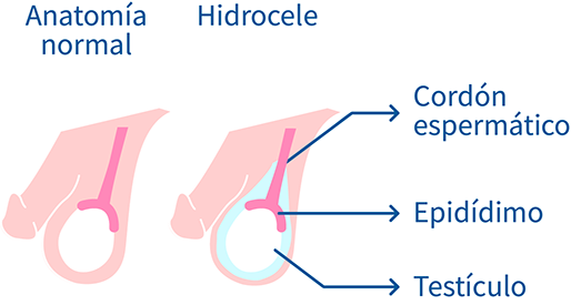 Hidrocele