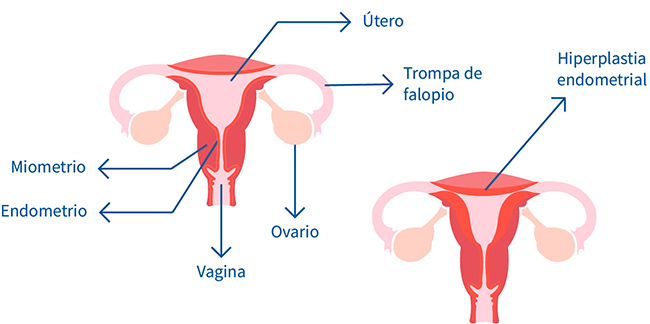 Hiperplasia endometrial