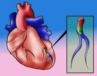 Corazon y arterias coronarias