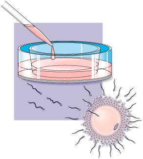 Fertilizacion in vitro