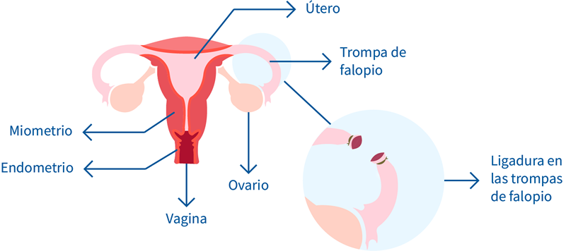 Ligadura Trompas