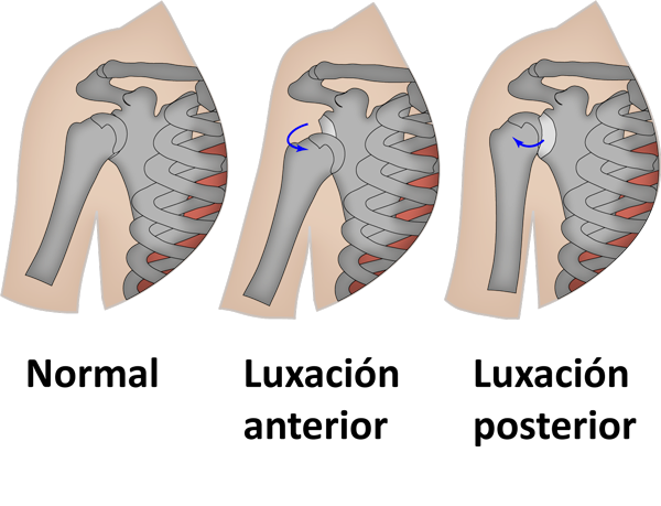 Luxación del hombro