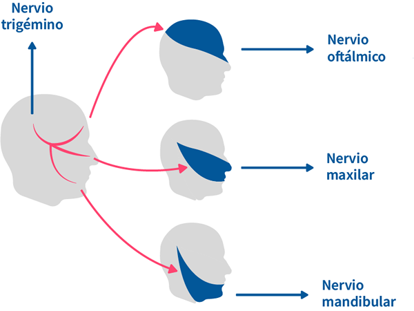 neuralgia del nervio trigemino