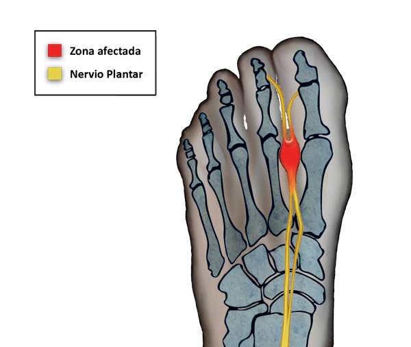 Neuroma de morton