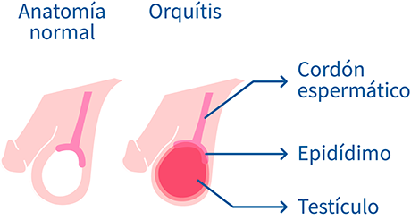 Orquitis