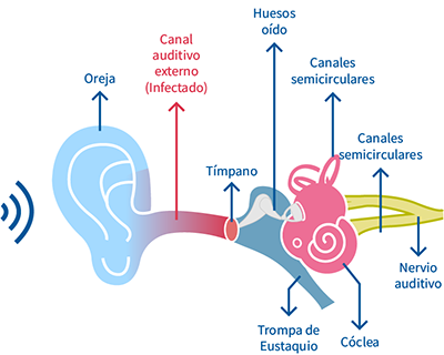 otitis aguda externa