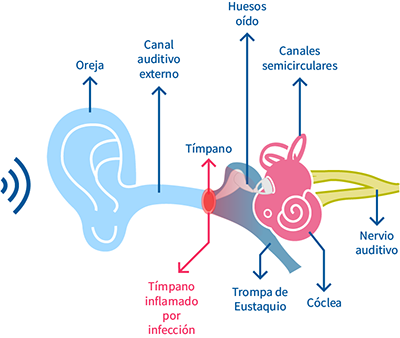 otitis media