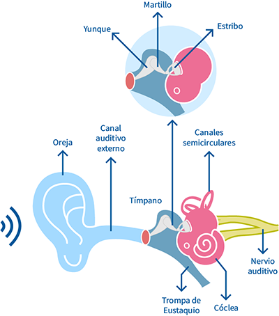 otosclerosis